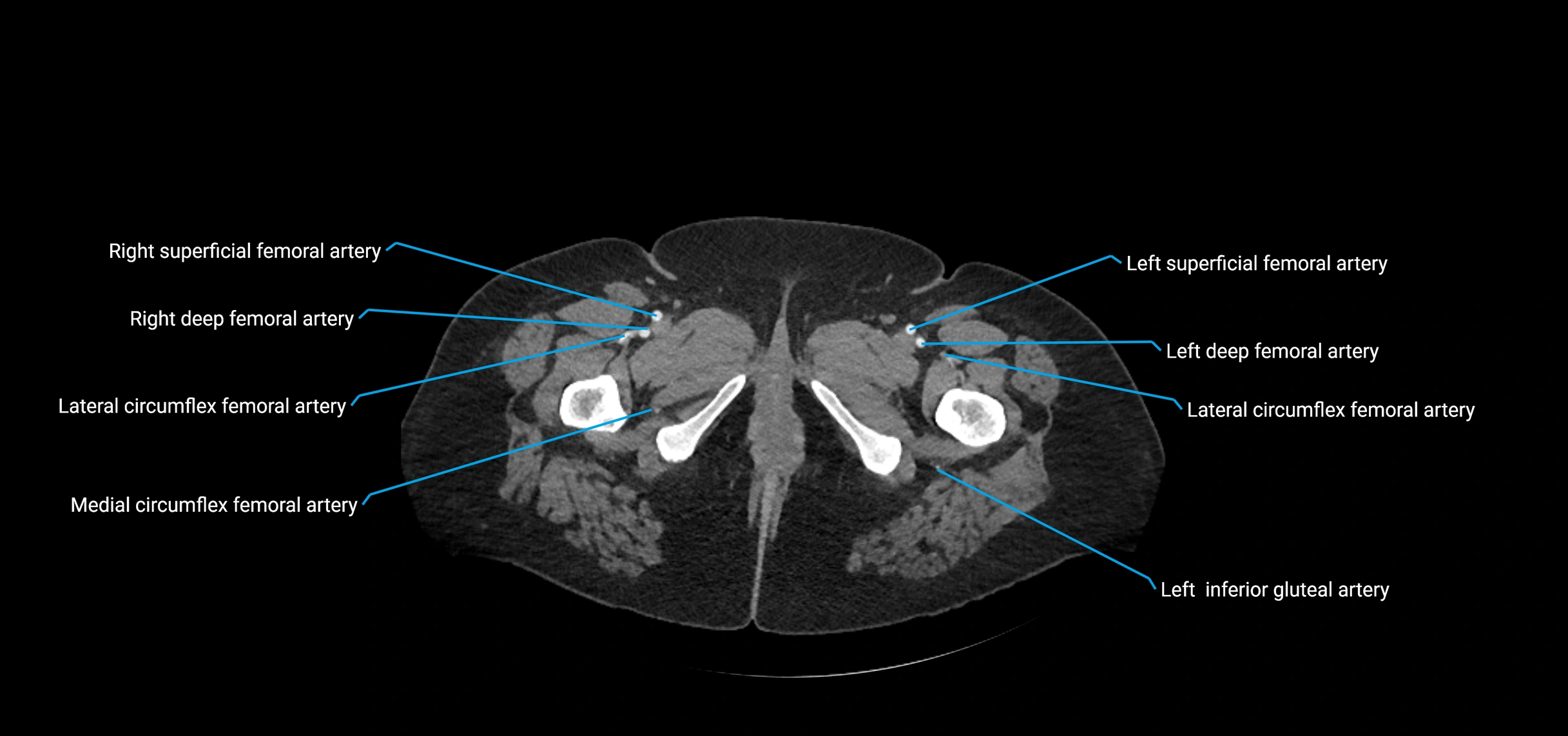 CTA abdomen axial cross sectional anatomy labelled image_281 (2).webp